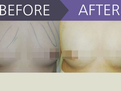 가슴지방이식 2차