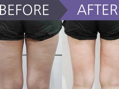 허벅지 지방흡입 전후